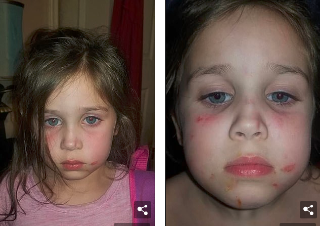 5歲的女孩臉上滿是瘀傷，原來在校車上被毆打了45分鐘