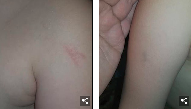 5歲的女孩臉上滿是瘀傷，原來在校車上被毆打了45分鐘